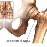 Как предотвратить развитие остеопороза