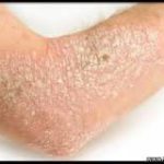 Правила для профилактики псориаза