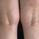 Варикозное расширение вен: диагностика и лечение