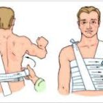 Перелом ребра: симптомы и лечение