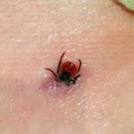 В Кыргызстане трое укушенных клещами заболели энцефалитом