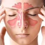 Как лечить гайморит в домашних условиях