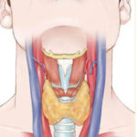 Зоб: разновидности и лечение
