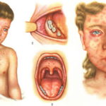 Народная медицина против кори