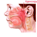 Аденоиды и гланды: удалять или не стоит
