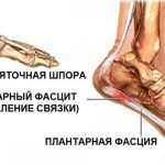 Реальная история лечения пяточной шпоры