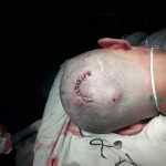 Бишкекские нейрохирурги спасли пациента, который пришел к врачам с пулей в голове