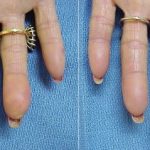 Кальциноз: Лечение народными средствами