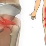 Волшебный рецепт для тех, кто страдает защемлением седалищного нерва