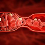 Тромб в сосудах: первые признаки, которые нельзя игнорировать