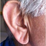 Симптом инфаркта: необычный знак на ухе