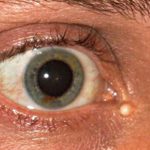 Если в уголке глаза жировик