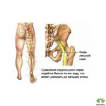 Древний рецепт для облегчения боли в седалищном нерве