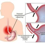 Как лечить желудочный рефлюкс
