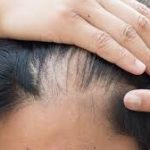 Почему у переболевших COVID-19 сильно выпадают волосы? Ответы трихолога
