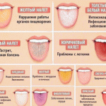 Белый, желтый и коричневый: о каких болезнях говорит цвет налета на языке