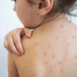 С начала 2024 года в стране выявлено 536 случаев кори