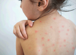 С начала 2024 года в стране выявлено 536 случаев кори