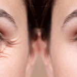 Мешки под глазами: причины и как их убрать