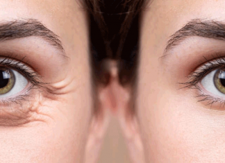 Мешки под глазами: причины и как их убрать