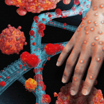 Оспа обезьян: что важно знать